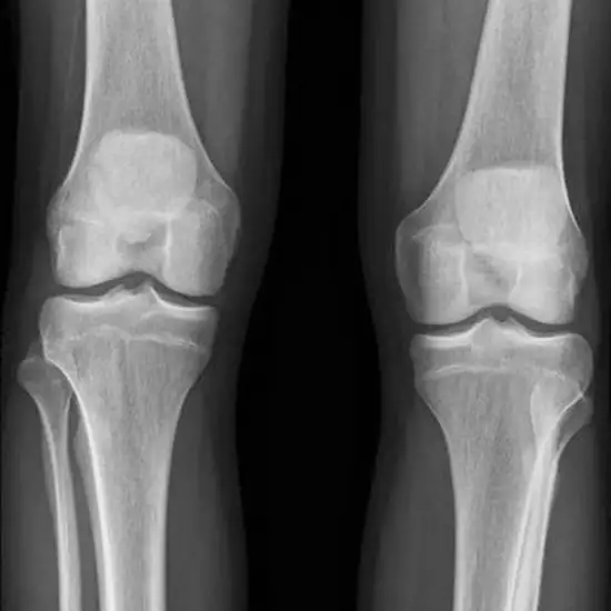 x-ray bilateral knee ap standing view